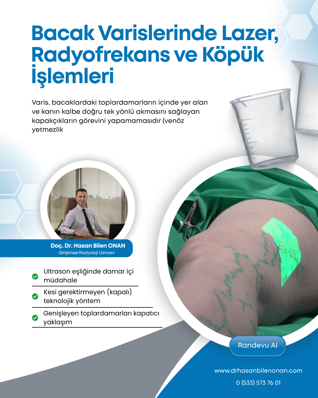 Bacak Varislerinde Lazer, Radyofrekans ve Köpük İşlemleri