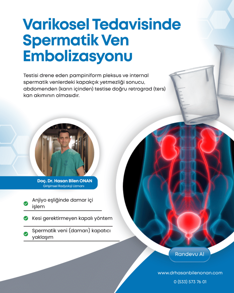 Varikosel Tedavisinde Spermatik Ven Embolizasyonu Varikosel Tedavisinde Spermatik Ven Embolizasyonu