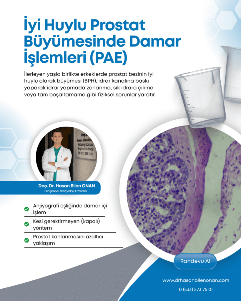 Benign Prostat Hiperplazisinde Prostat Arteri Embolizasyonu (PAE) Benign Prostat Hiperplazisinde Prostat Arteri Embolizasyonu (PAE)